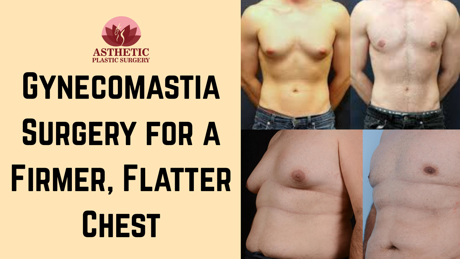 Gynecomastia Surgery for a Firmer, Flatter Chest